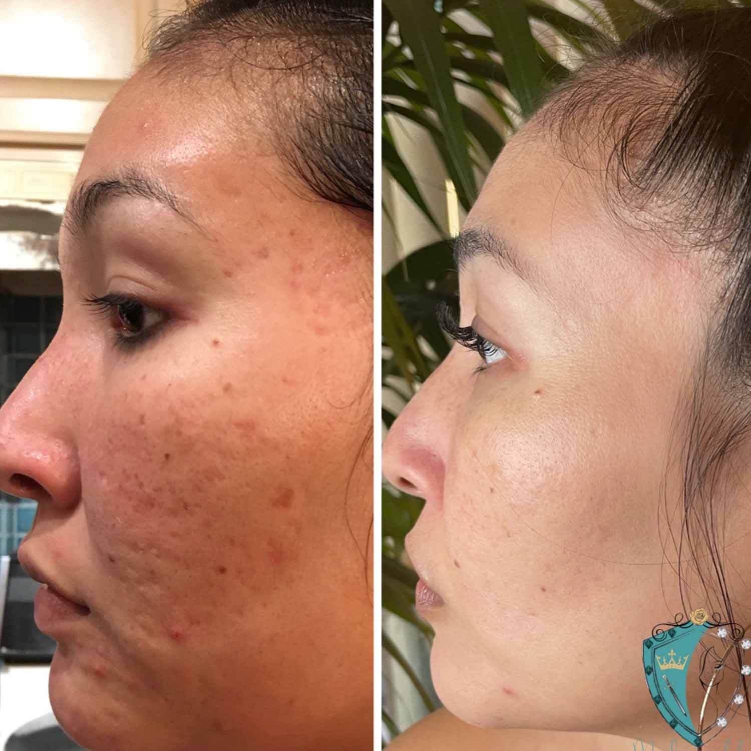 Acne Facial South Bay