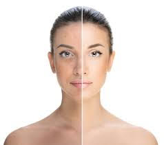 DMK Cosmelan Depigmentation Peel South Bay